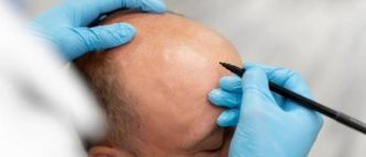 trasplante capilar procedimiento quirúrgico estético sencillo de efectuar